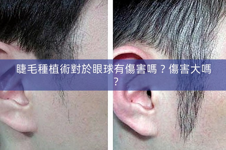 睫毛種植術對於眼球有傷害嗎？傷害大嗎？