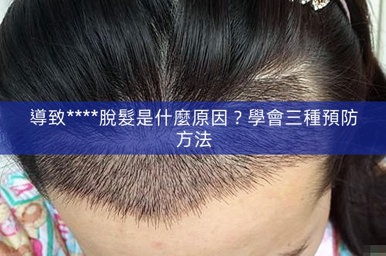 導致****脫髮是什麼原因？學會三種預防方法