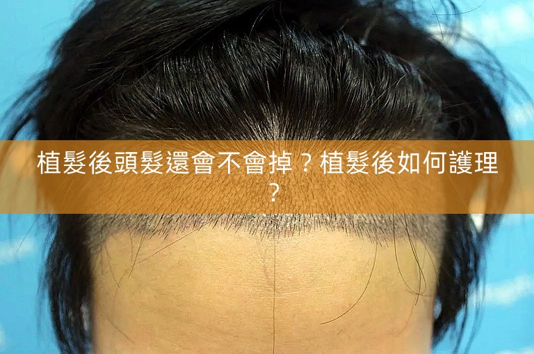 植髮後頭髮還會不會掉?植髮後如何護理? 植髮後頭髮還會不會掉?植髮後如何護理?