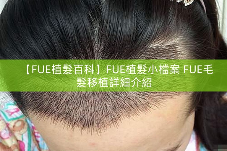 【FUE植髮百科】FUE植髮小檔案 FUE毛髮移植詳細介紹 【FUE植髮百科】FUE植髮小檔案 FUE毛髮移植詳細介紹