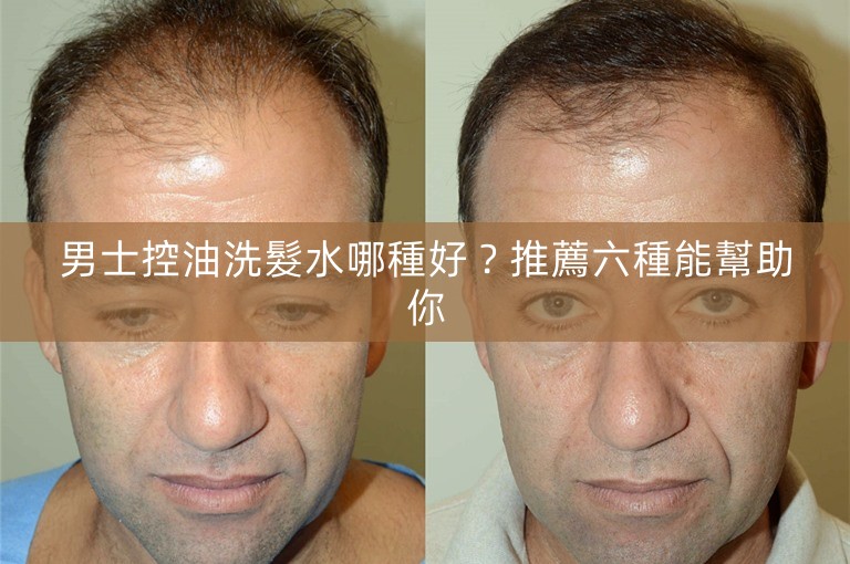男士控油洗髮水哪種好？推薦六種能幫助你