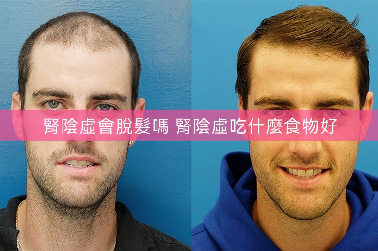 腎陰虛會脫髮嗎 腎陰虛吃什麼食物好 腎陰虛會脫髮嗎 腎陰虛吃什麼食物好