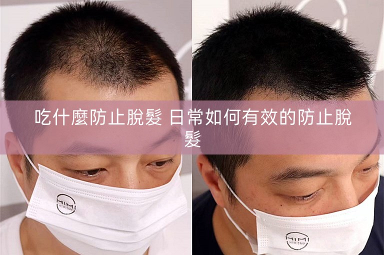 吃什麼防止脫髮 日常如何有效的防止脫髮