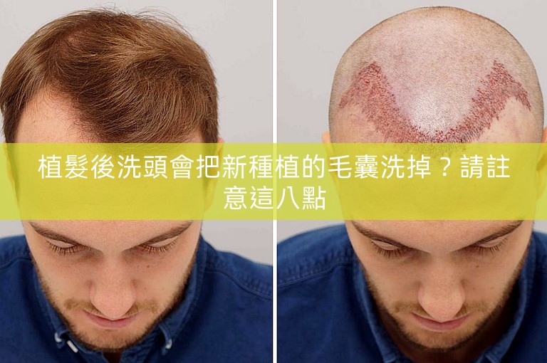 植髮後洗頭會把新種植的毛囊洗掉？請註意這八點