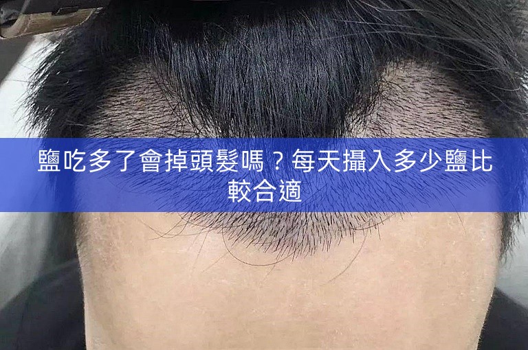 鹽吃多了會掉頭髮嗎?每天攝入多少鹽比較合適 鹽吃多了會掉頭髮嗎?每天攝入多少鹽比較合適