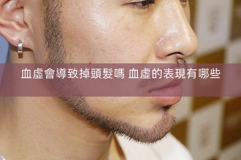 血虛會導致掉頭髮嗎 血虛的表現有哪些 