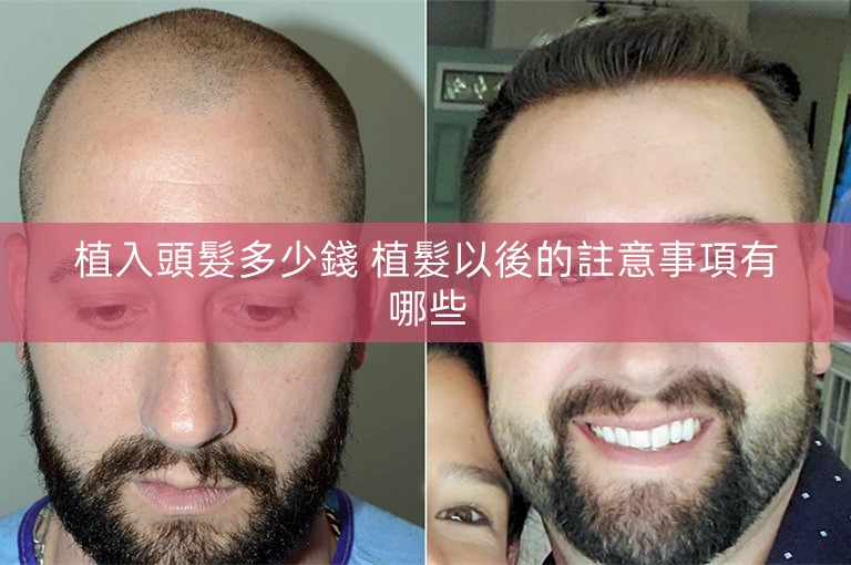 植入頭髮多少錢 植髮以後的註意事項有哪些