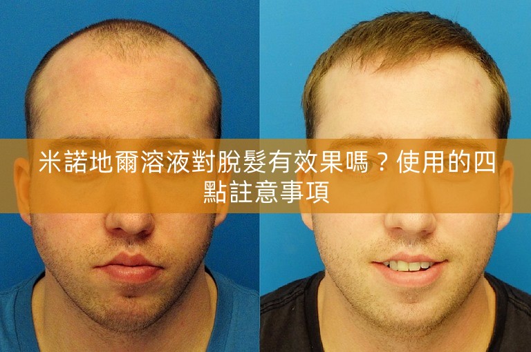 米諾地爾溶液對脫髮有效果嗎?使用的四點註意事項 米諾地爾溶液對脫髮有效果嗎?使用的四點註意事項