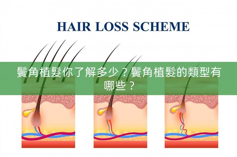 鬢角植髮你了解多少？鬢角植髮的類型有哪些？