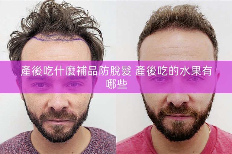 產後吃什麼補品防脫髮 產後吃的水果有哪些