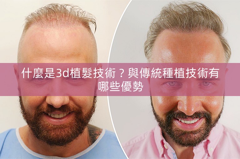 什麼是3d植髮技術？與傳統種植技術有哪些優勢