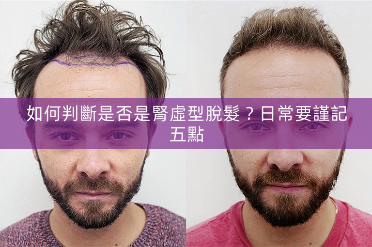 如何判斷是否是腎虛型脫髮？日常要謹記五點