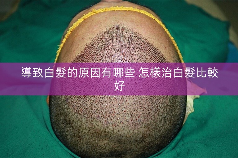 導致白髮的原因有哪些 怎樣治白髮比較好 導致白髮的原因有哪些 怎樣治白髮比較好