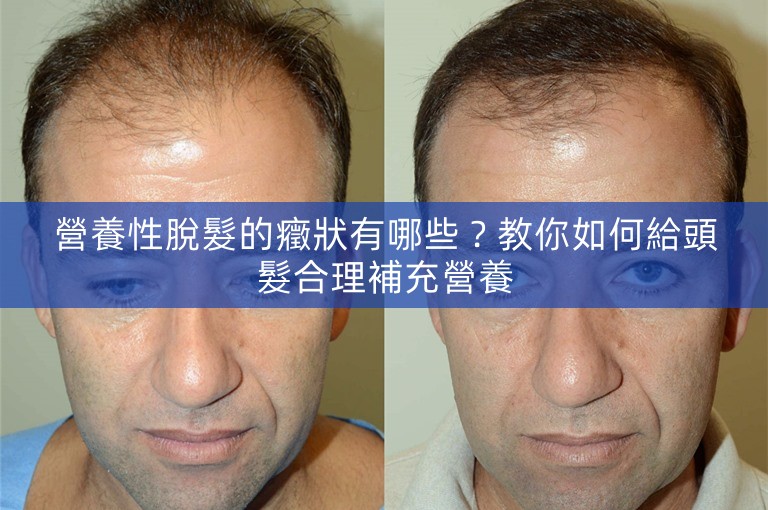 營養性脫髮的癥狀有哪些？教你如何給頭髮合理補充營養