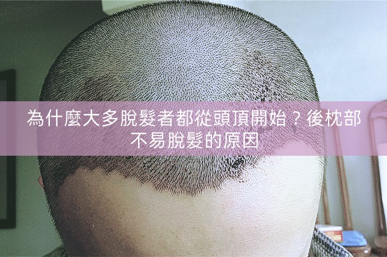 為什麼大多脫髮者都從頭頂開始？後枕部不易脫髮的原因