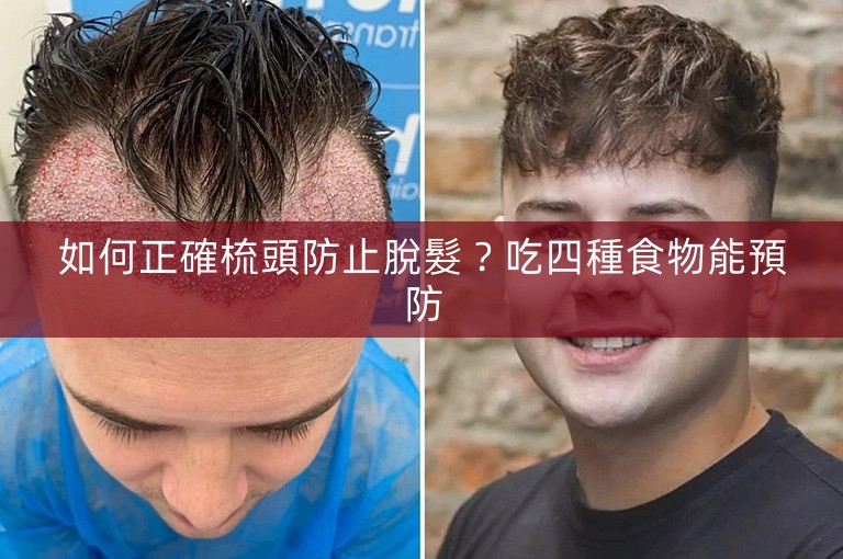 如何正確梳頭防止脫髮?吃四種食物能預防 如何正確梳頭防止脫髮?吃四種食物能預防