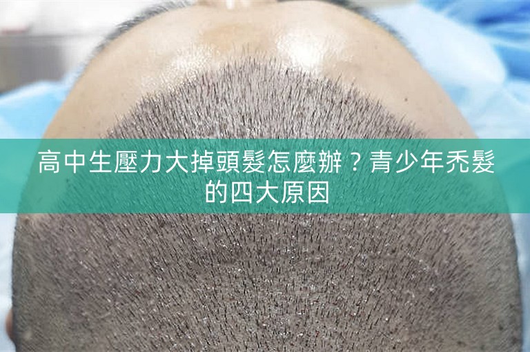 高中生壓力大掉頭髮怎麼辦？青少年禿髮的四大原因
