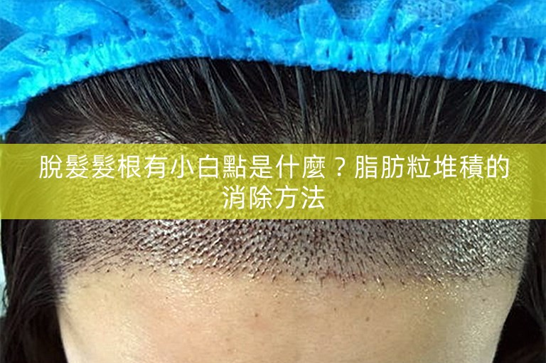 脫髮髮根有小白點是什麼？脂肪粒堆積的消除方法