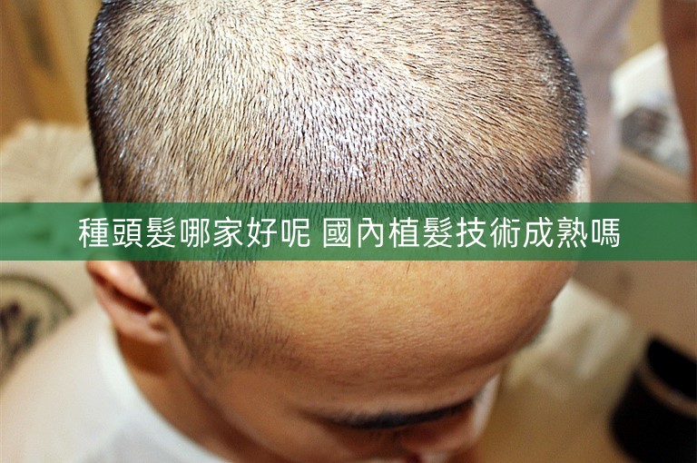 種頭髮哪家好呢 國內植髮技術成熟嗎 種頭髮哪家好呢 國內植髮技術成熟嗎