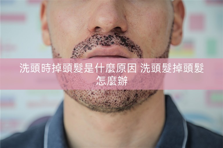 洗頭時掉頭髮是什麼原因 洗頭髮掉頭髮怎麼辦