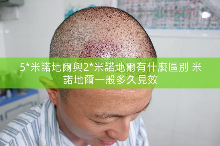 5*米諾地爾與2*米諾地爾有什麼區別 米諾地爾一般多久見效