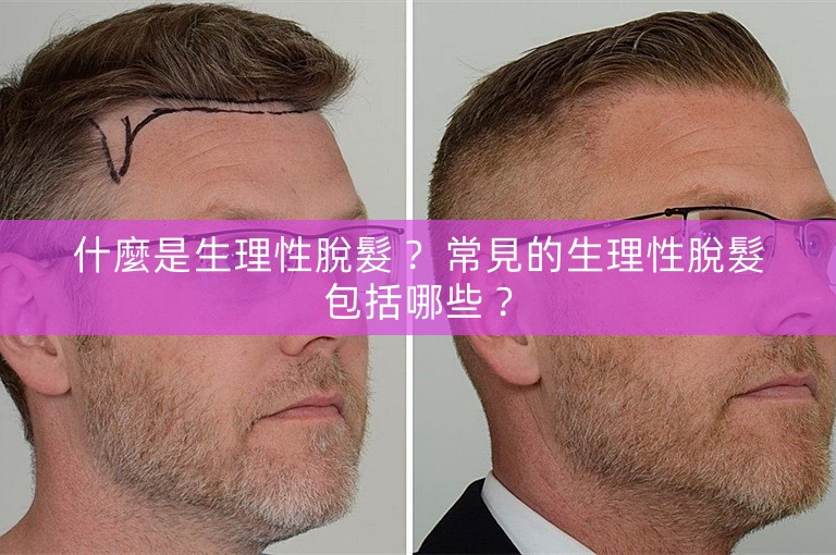 什麼是生理性脫髮？ 常見的生理性脫髮包括哪些？