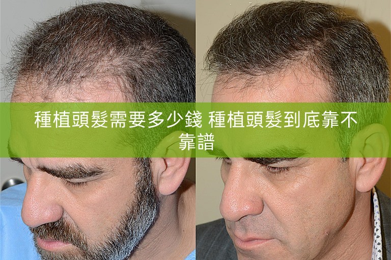 種植頭髮需要多少錢 種植頭髮到底靠不靠譜
