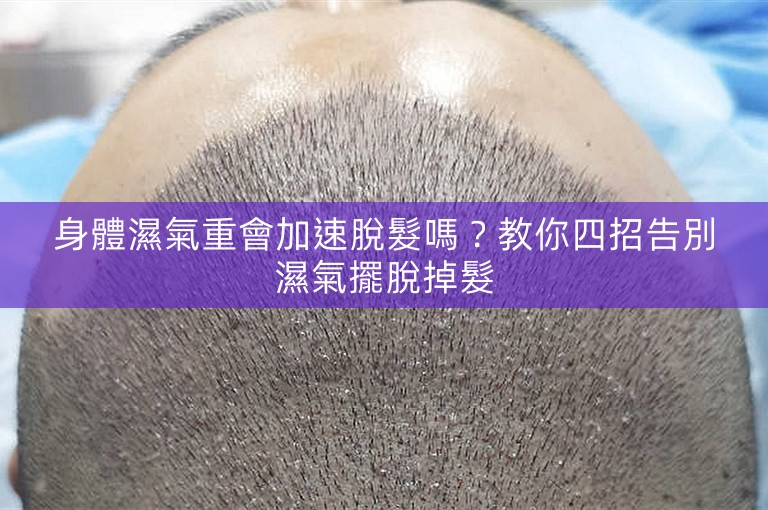 身體濕氣重會加速脫髮嗎？教你四招告別濕氣擺脫掉髮