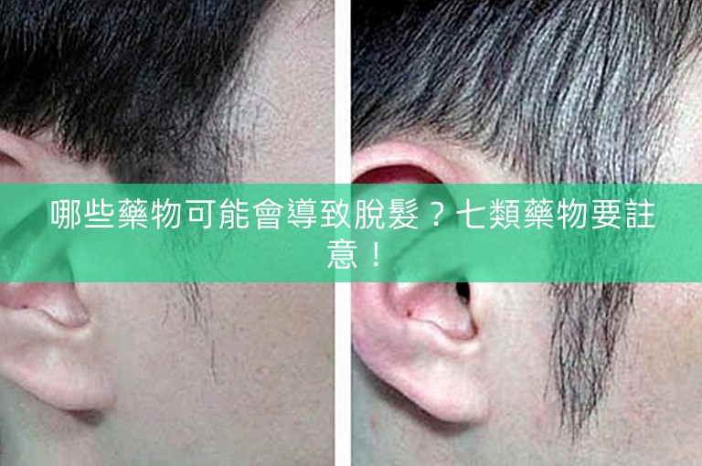 哪些藥物可能會導致脫髮？七類藥物要註意！