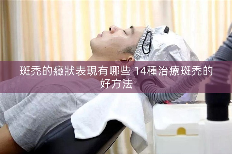 斑禿的癥狀表現有哪些 14種治療斑禿的好方法