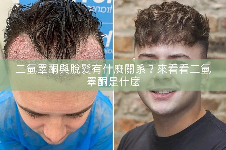 二氫睪酮與脫髮有什麼關系？來看看二氫睪酮是什麼