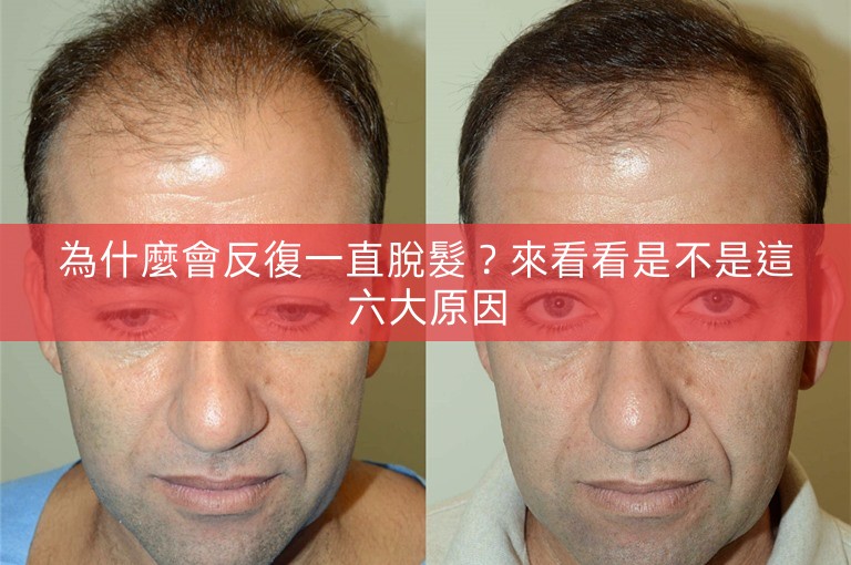 為什麼會反復一直脫髮？來看看是不是這六大原因