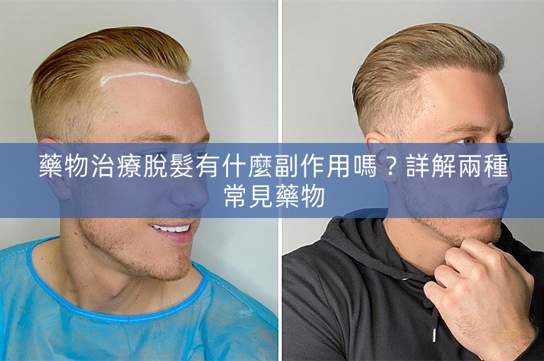藥物治療脫髮有什麼副作用嗎？詳解兩種常見藥物