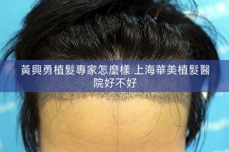 黃興勇植髮專家怎麼樣 上海華美植髮醫院好不好