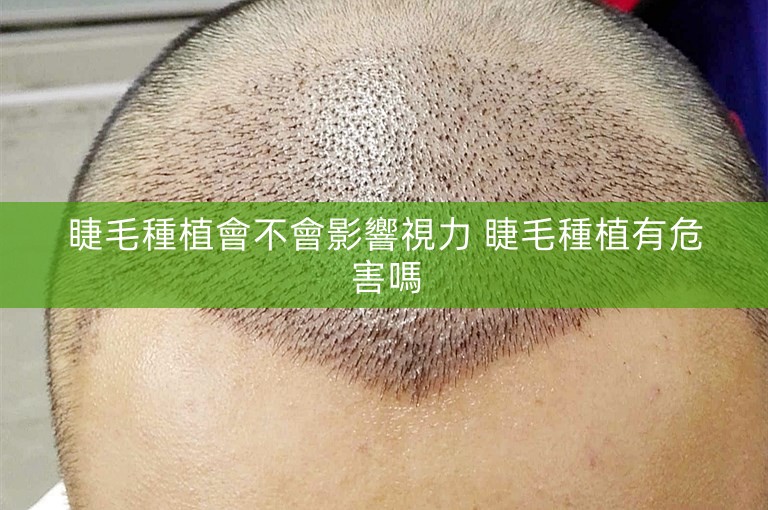 睫毛種植會不會影響視力 睫毛種植有危害嗎