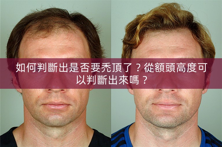 如何判斷出是否要禿頂了？從額頭高度可以判斷出來嗎？