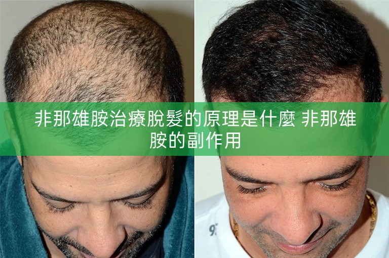 非那雄胺治療脫髮的原理是什麼 非那雄胺的副作用