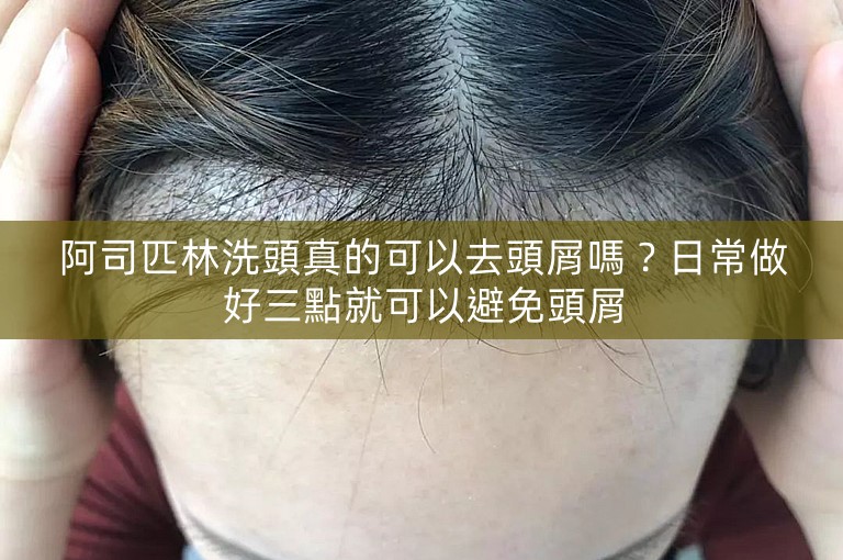 阿司匹林洗頭真的可以去頭屑嗎?日常做好三點就可以避免頭屑 阿司匹林洗頭真的可以去頭屑嗎?日常做好三點就可以避免頭屑