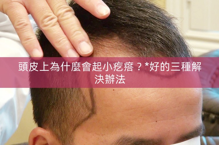 頭皮上為什麼會起小疙瘩？*好的三種解決辦法