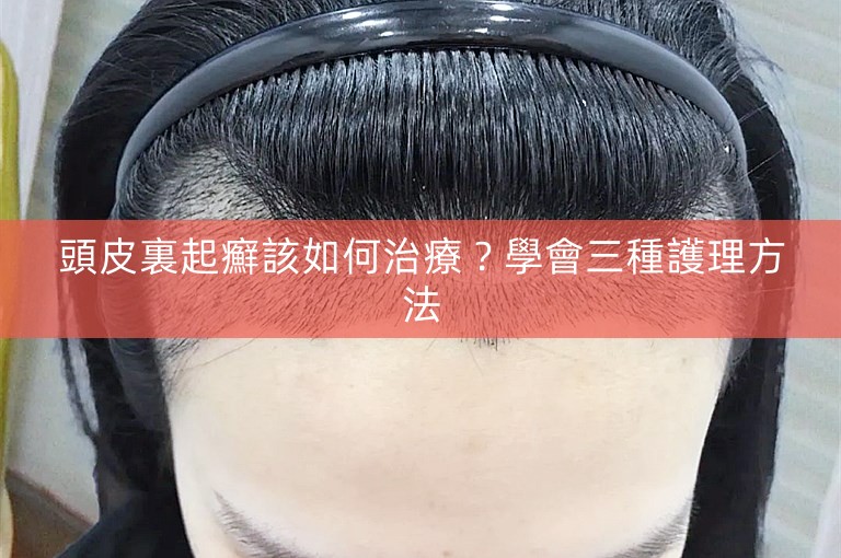 頭皮裏起癬該如何治療?學會三種護理方法 頭皮裏起癬該如何治療?學會三種護理方法