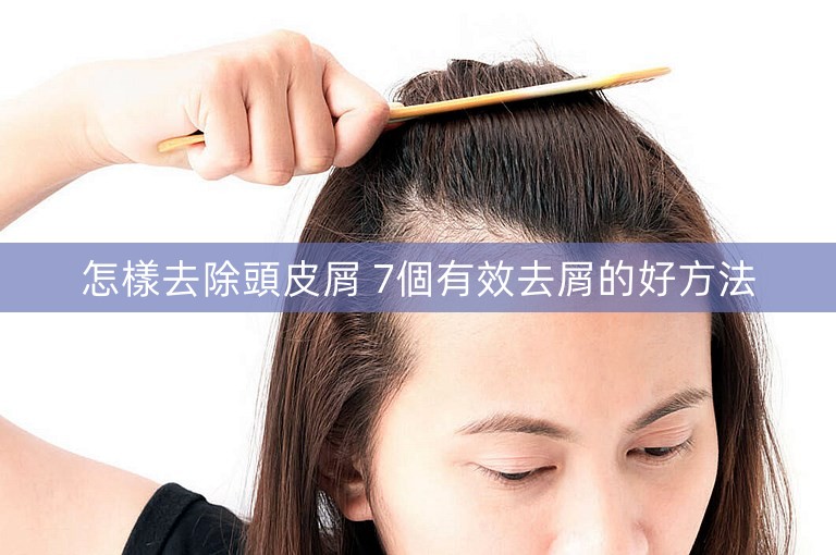 怎樣去除頭皮屑 7個有效去屑的好方法