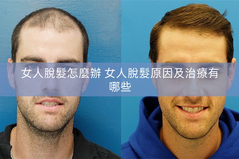 女人脫髮怎麼辦 女人脫髮原因及治療有哪些 女人脫髮怎麼辦 女人脫髮原因及治療有哪些