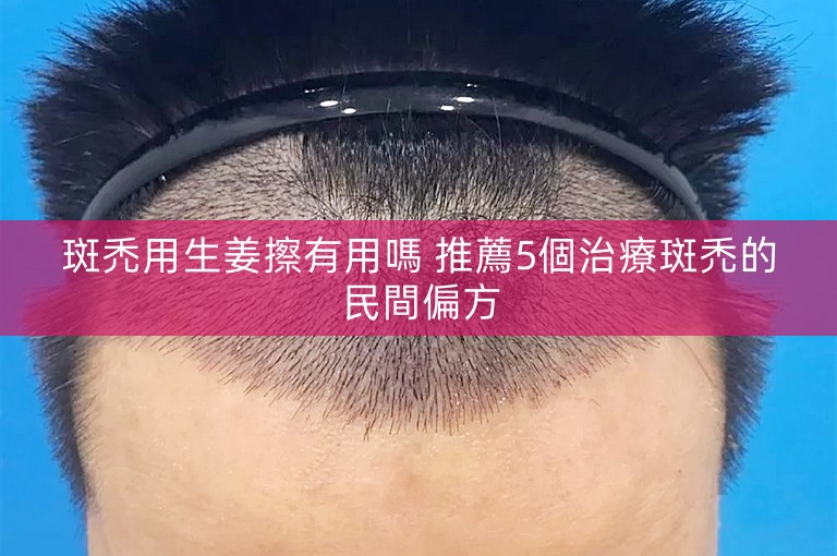 斑禿用生姜擦有用嗎 推薦5個治療斑禿的民間偏方