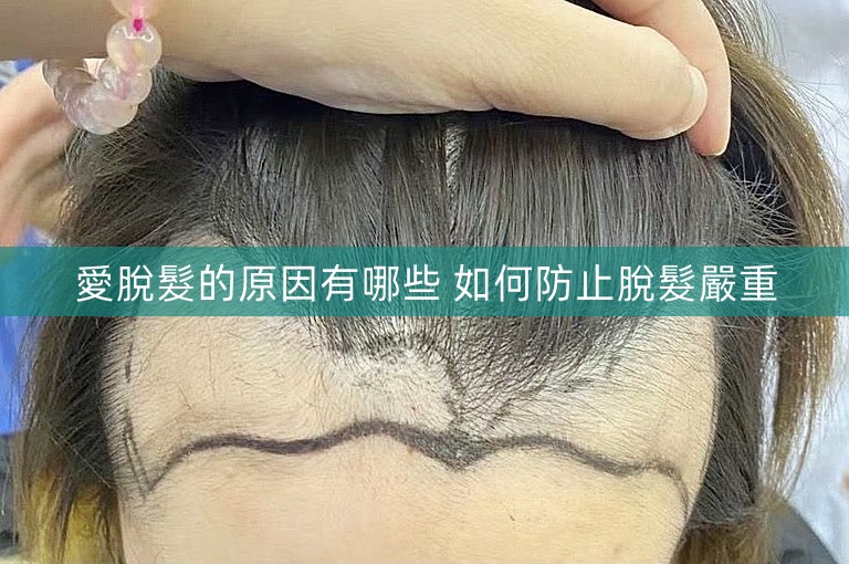 愛脫髮的原因有哪些 如何防止脫髮嚴重