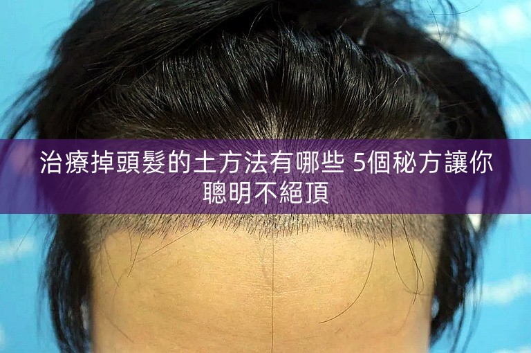 治療掉頭髮的土方法有哪些 5個秘方讓你聰明不絕頂 治療掉頭髮的土方法有哪些 5個秘方讓你聰明不絕頂