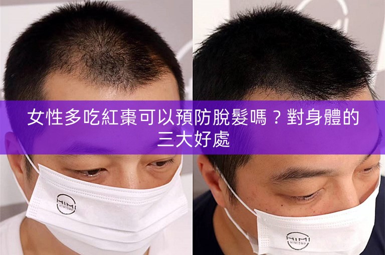 女性多吃紅棗可以預防脫髮嗎？對身體的三大好處