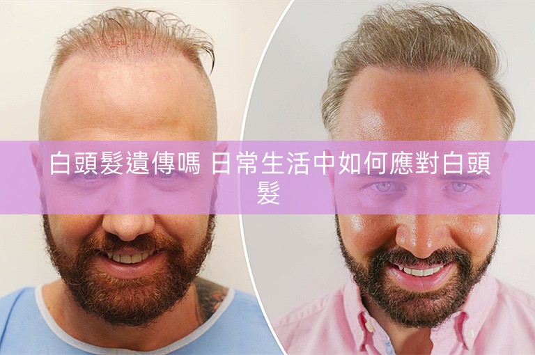 白頭髮遺傳嗎 日常生活中如何應對白頭髮