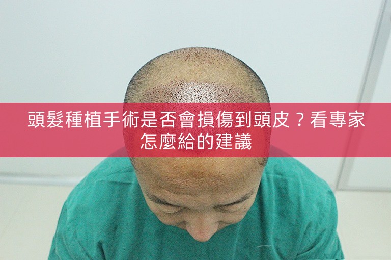 頭髮種植手術是否會損傷到頭皮？看專家怎麼給的建議