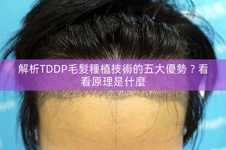 解析TDDP毛髮種植技術的五大優勢？看看原理是什麼