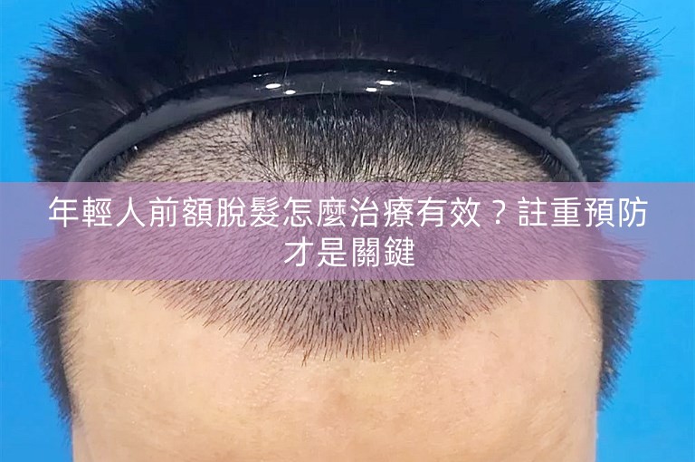 年輕人前額脫髮怎麼治療有效?註重預防才是關鍵 年輕人前額脫髮怎麼治療有效?註重預防才是關鍵